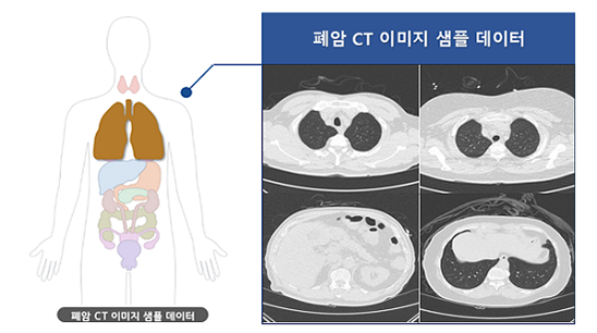 폐암 CT 이미지 샘플 데이터